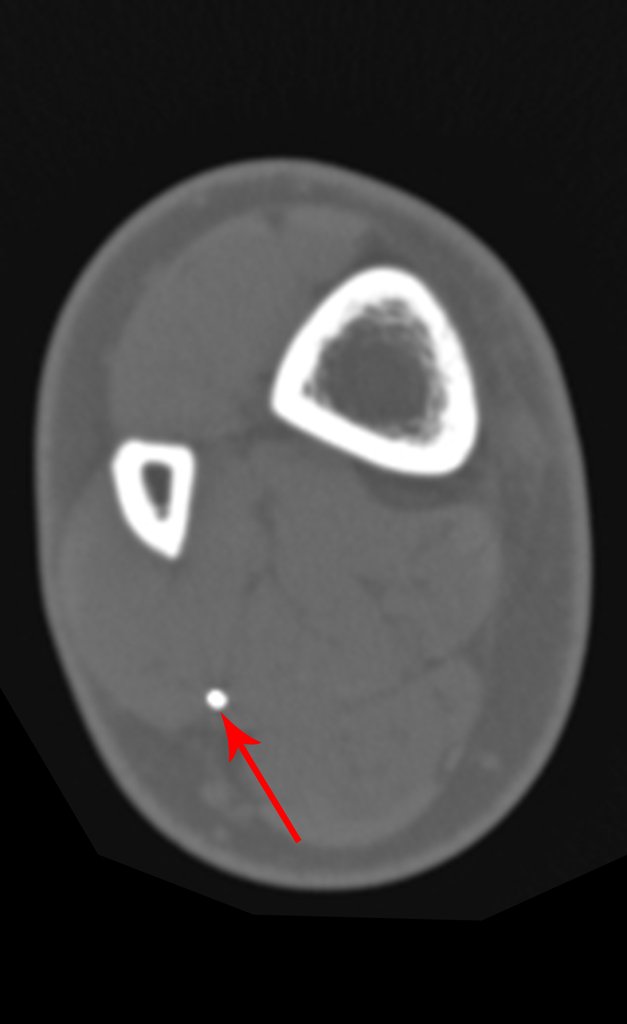 Figura 19: Tomografia axial com seta em vermelho destacando imagem densa no septo intermuscular do flexor longo do hálux. A quê corresponde esta imagem???