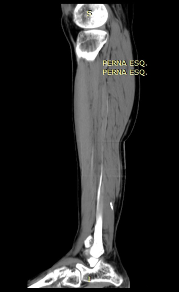 Figura 26: Tomografia coronal com densidade de tecidos moles com persistência do artefato.