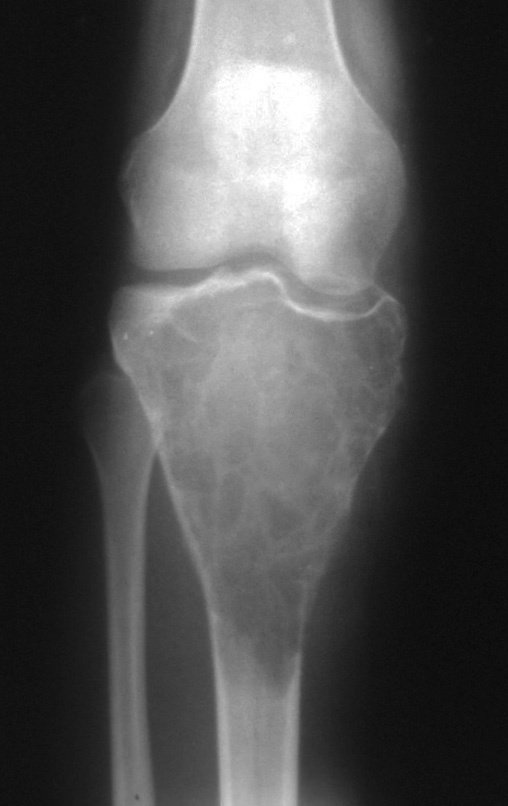 Figura 2: Radiografia, frente, com grande lesão de rarefação óssea ocupando toda a epífise proximal da tibia direita, com afundamento do planalto medial.