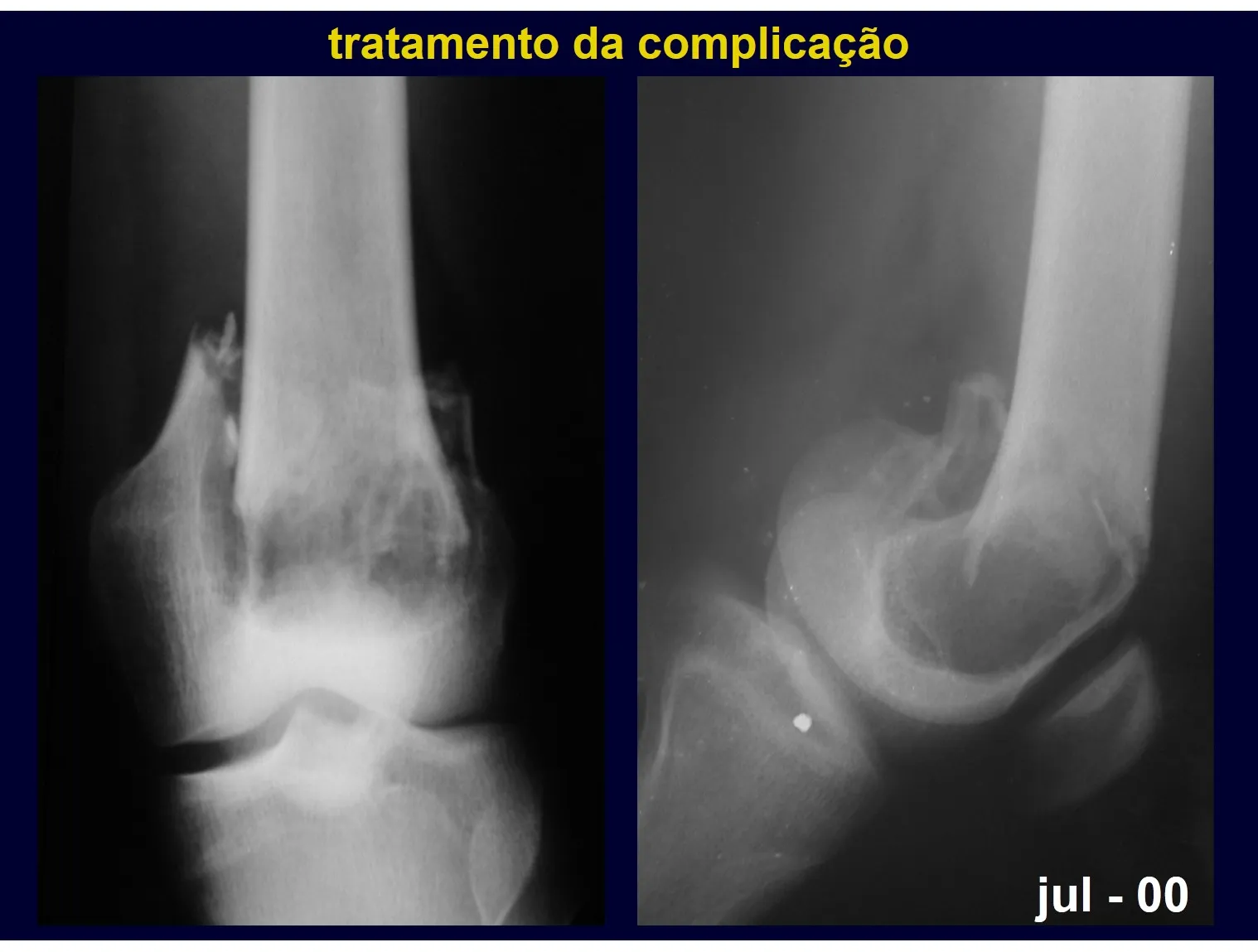 Figura 30 e 31: Grave fratura afundamento em cisto ósseo do fêmur.