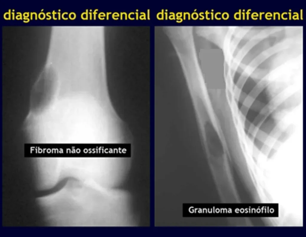 Figura 6: Defeito fibroso cortical. Figura 7: Granuloma eosinófilo.