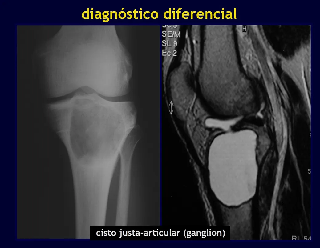 Figura 8: Cisto ósseo justa articular (ganglion). Figura 9: Após injeção de contraste.