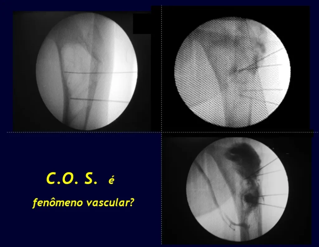 Figura 1: Cisto ósseo unicameral. Figura 2: Infiltração com contraste, Figura 3: Preenchimento do cisto e de vasos que drenam a cavidade.