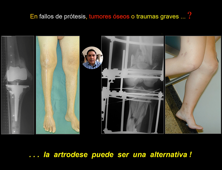 Artrodesis de rodilla con solución protésica o biológica