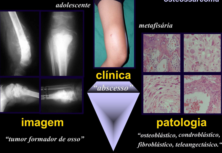 Diagnóstico de Tumores Ósseos