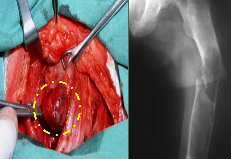 Fratura em Osso Patológico