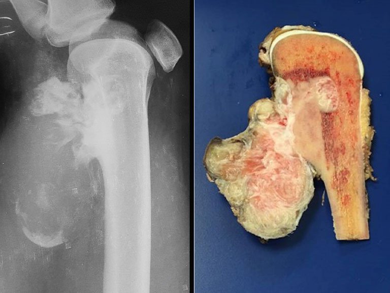 Osteossarcoma de Superfície